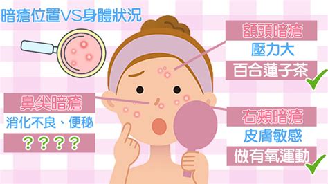 下巴底生暗瘡|9大暗瘡位置：下巴暗瘡=腎虧？中醫去暗瘡有用嗎？